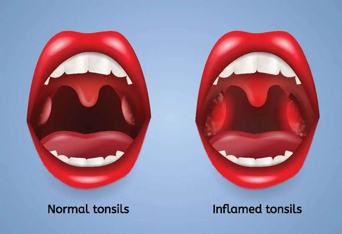 Can Tonsils Grow Back After Being Removed? - Tymoff